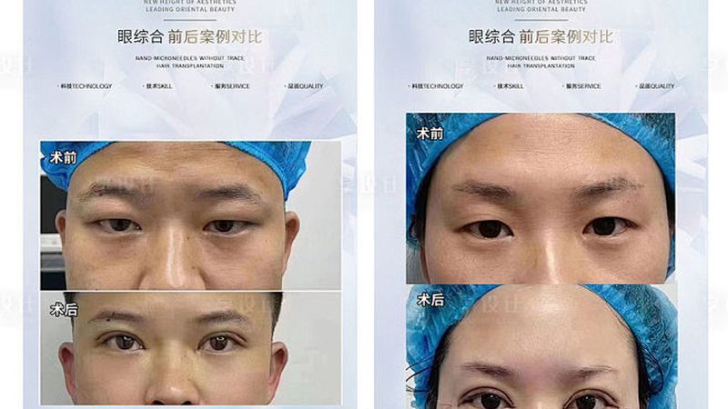 超声炮治疗：术前术后注意事项全解析**