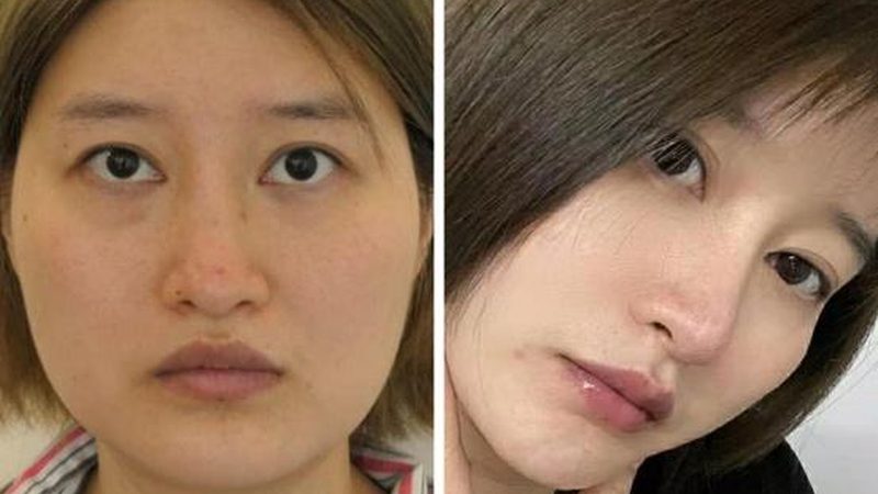 抗衰医美项目材料材质揭秘：分类与选择要点