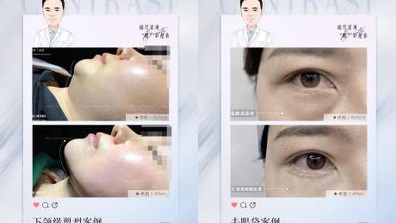 轻医美微整形面部填充区别