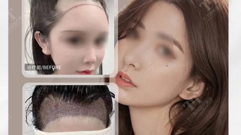 玻尿酸除皱后，这些注意事项你了解吗？**