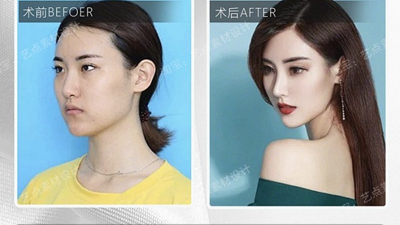 小标题：埋线双眼皮与全切双眼皮的原理