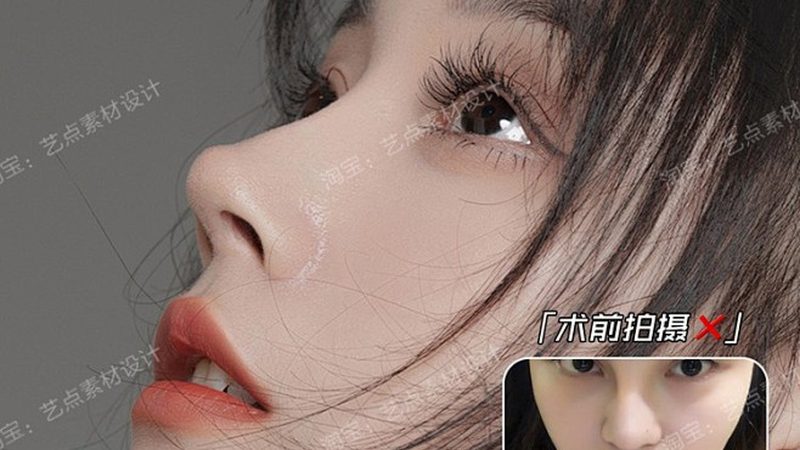 埋线提升法令纹，效果显现需耐心等待