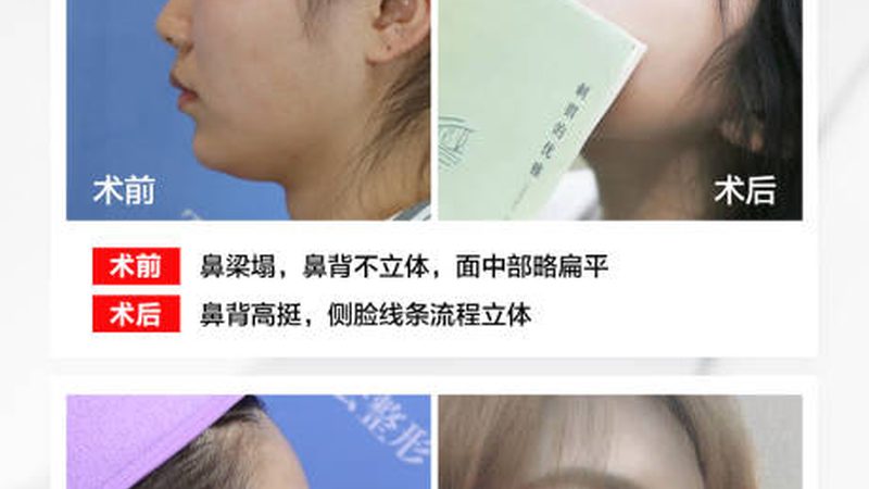 肉毒素注射后，你必须知道的五大注意事项