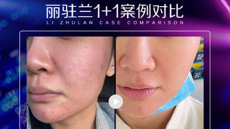 玻尿酸面膜：揭秘其制作工艺与选购要点
