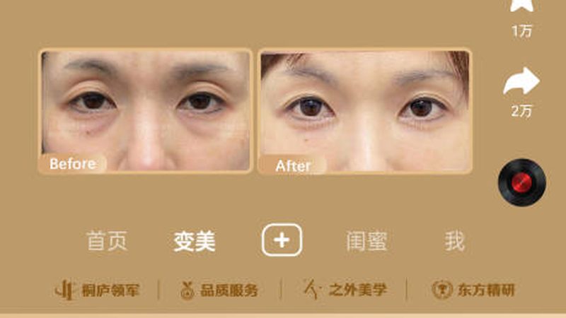 厦门双眼皮修复：揭秘不同方法的效果与选择